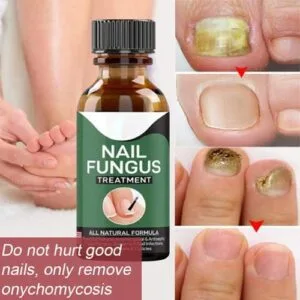 Alternative view of Nail Fungus Repair Serum (10ml): Get Healthy & Shiny Nails “Buy 1 Get 1 FREE!”